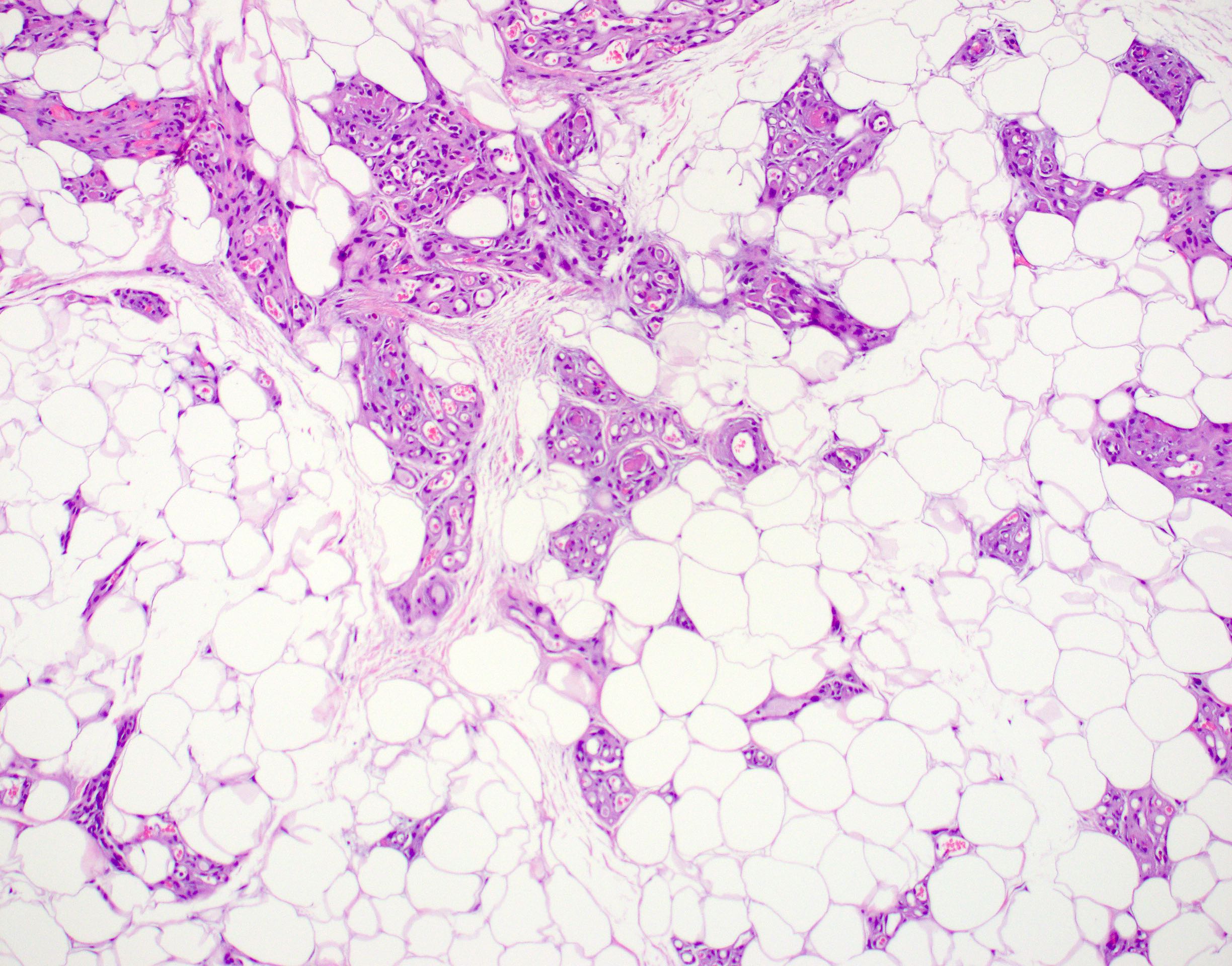 Angiolipoma Definition Causes And Treatment Angiolipoma Definition Causes And Treatment