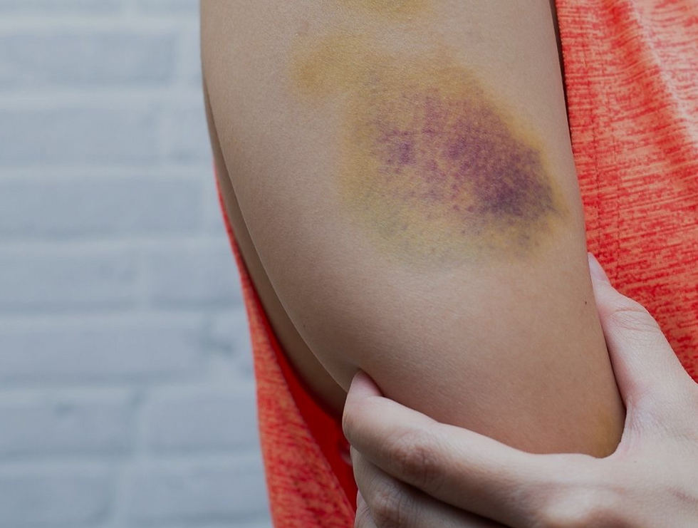 Bruises Why Does It Happens Symptoms Causes And Treatment Youtube Bruises Why Does It Happens Symptoms Causes And Treatment Youtube