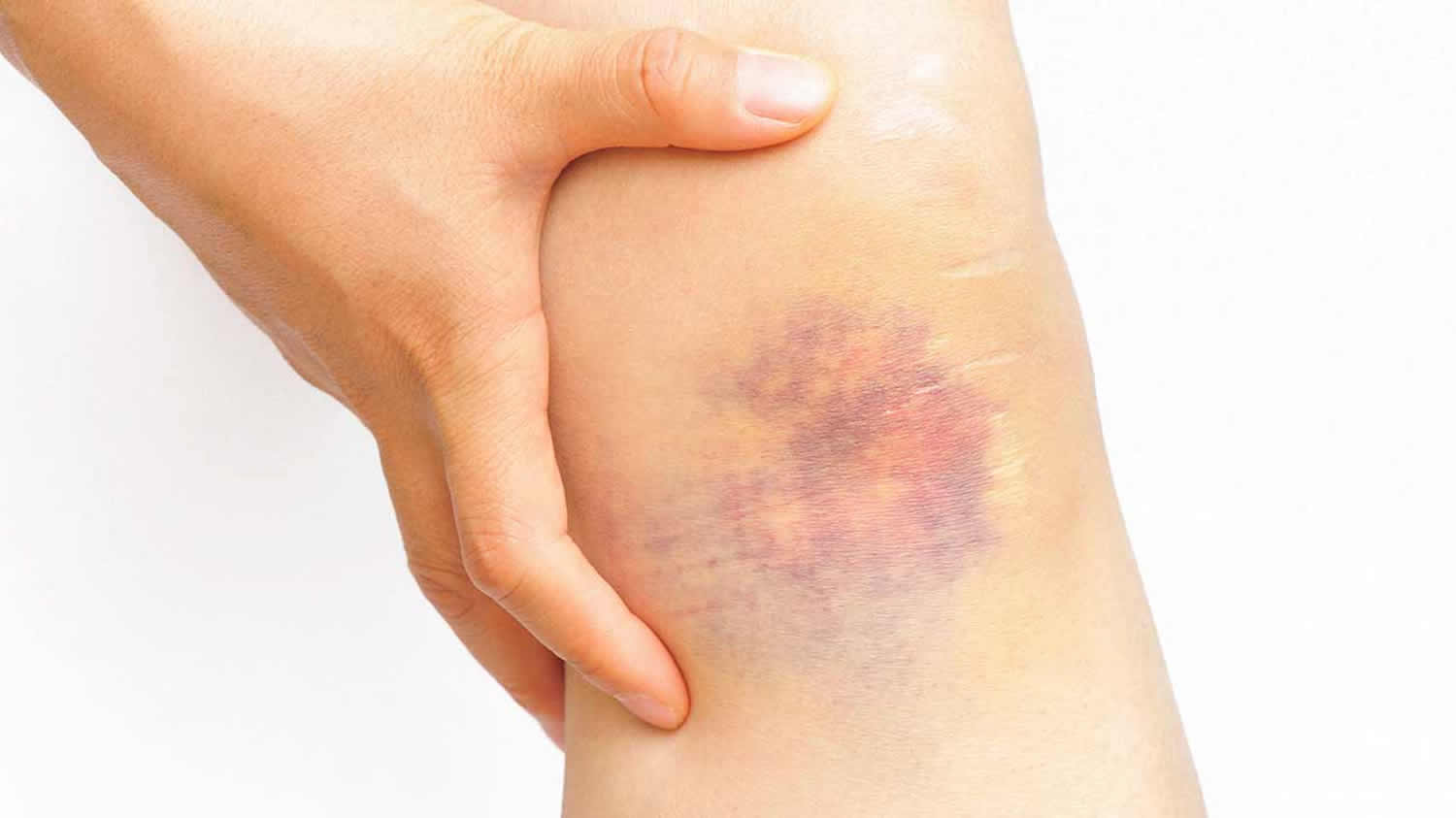 Bruising Hands And Arms American Osteopathic College Of Dermatology Bruising Hands And Arms American Osteopathic College Of Dermatology