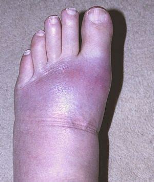 Can Gout Cause Bruising On Foot Hotsell Emergencydentistry Com Can Gout Cause Bruising On Foot Hotsell Emergencydentistry Com