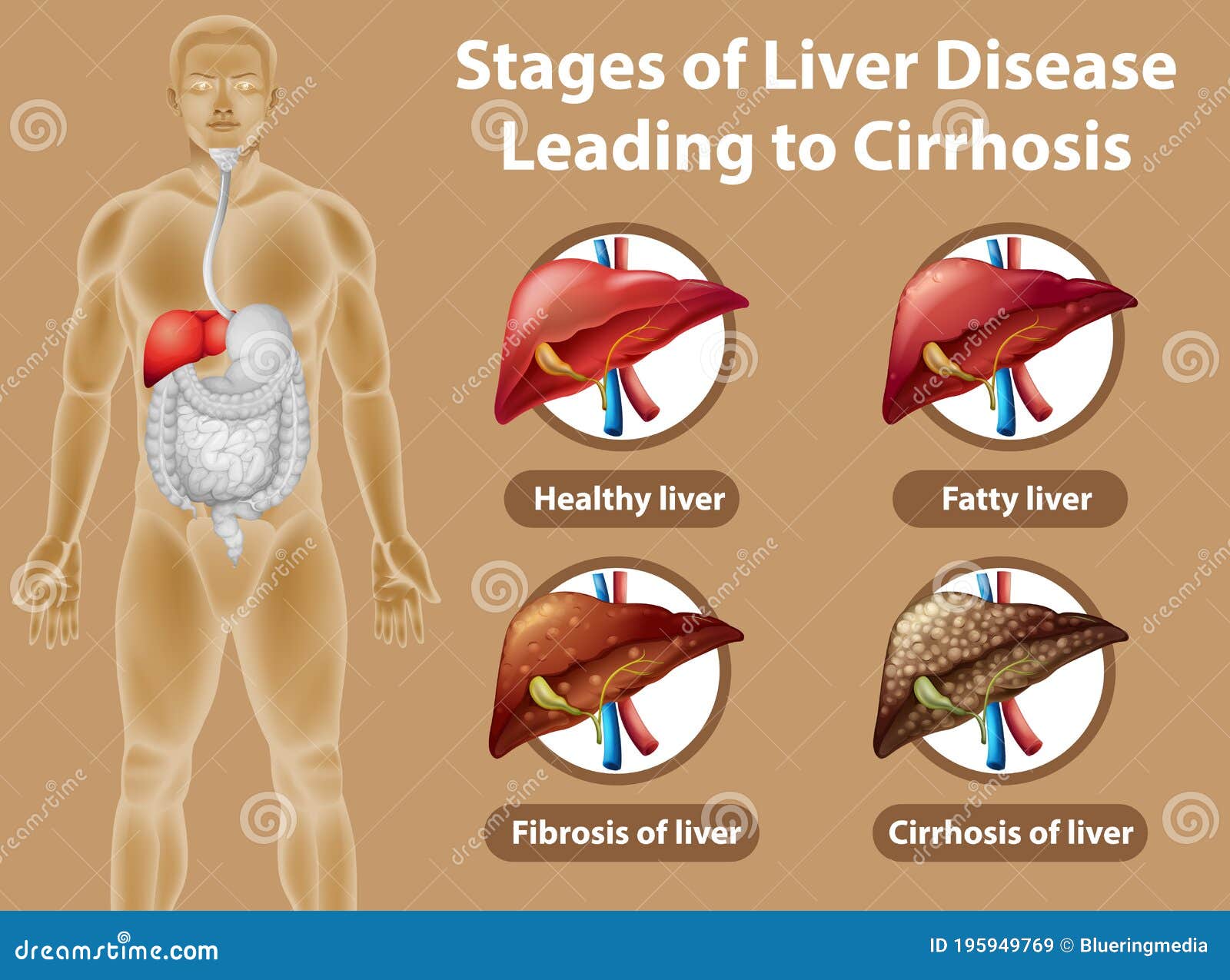Cirrhosis Ultrasound Cirrhosis Ultrasound