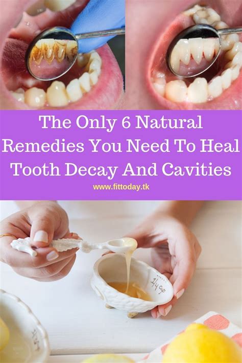 Cure Tooth Decay