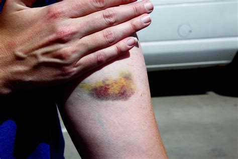Feeling Bruised All Over Body Feeling Bruised All Over Body