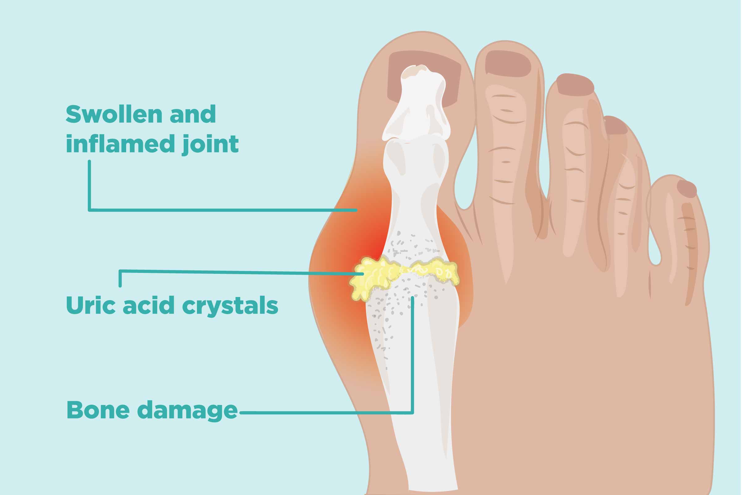 Gout Symptoms Causes Parkway Shenton Gout Symptoms Causes Parkway Shenton