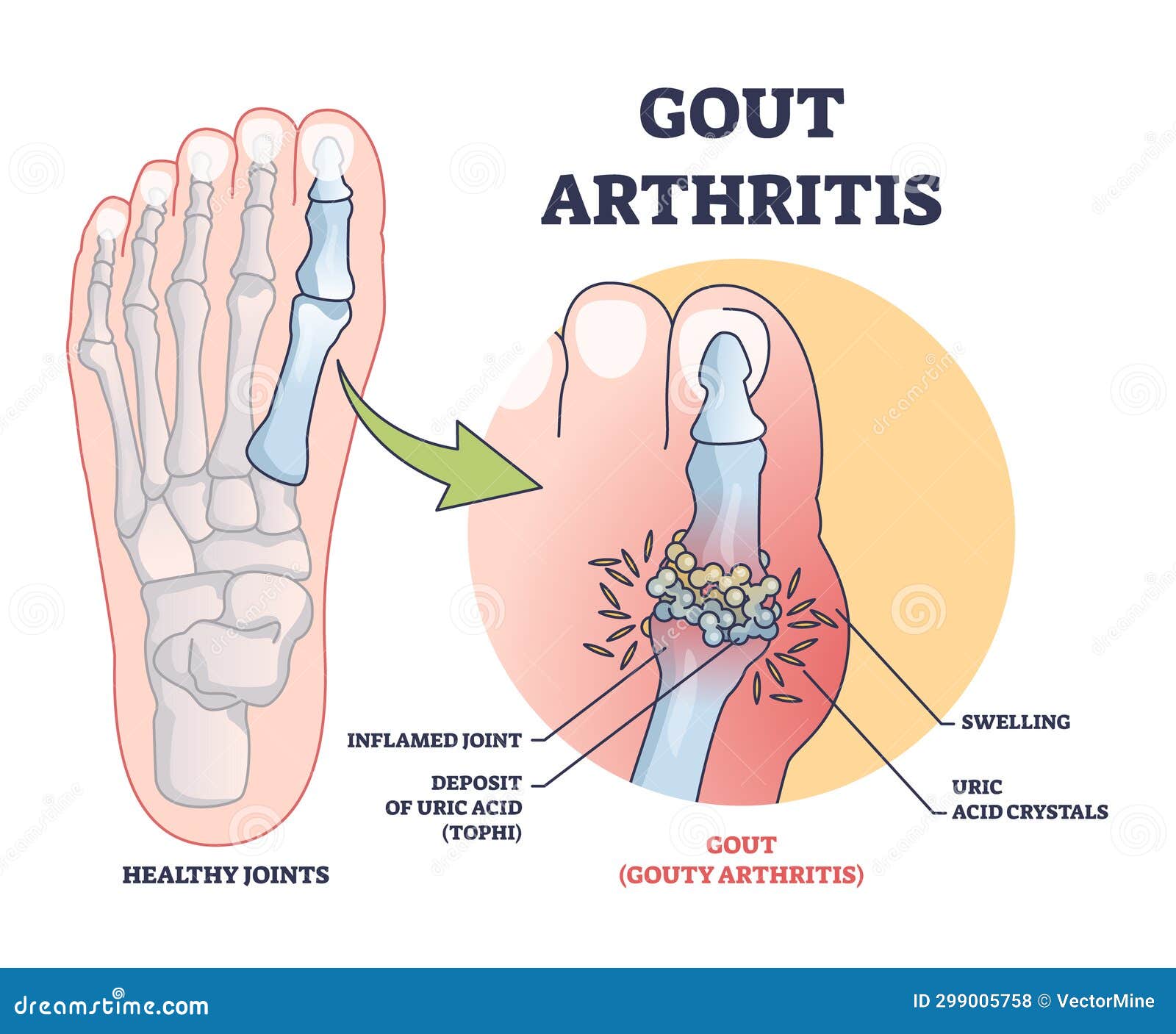 Gouty Arthritis With Inflamed Toe Joint Painful Condition Outline Gouty Arthritis With Inflamed Toe Joint Painful Condition Outline