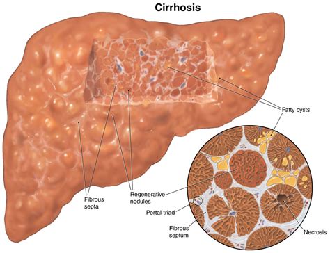 Hepatic Cirrhosis Of The Liver