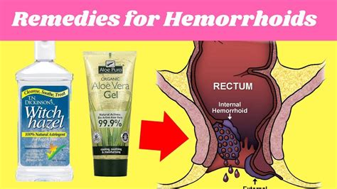 How To Help Hemorrhoid How To Help Hemorrhoid