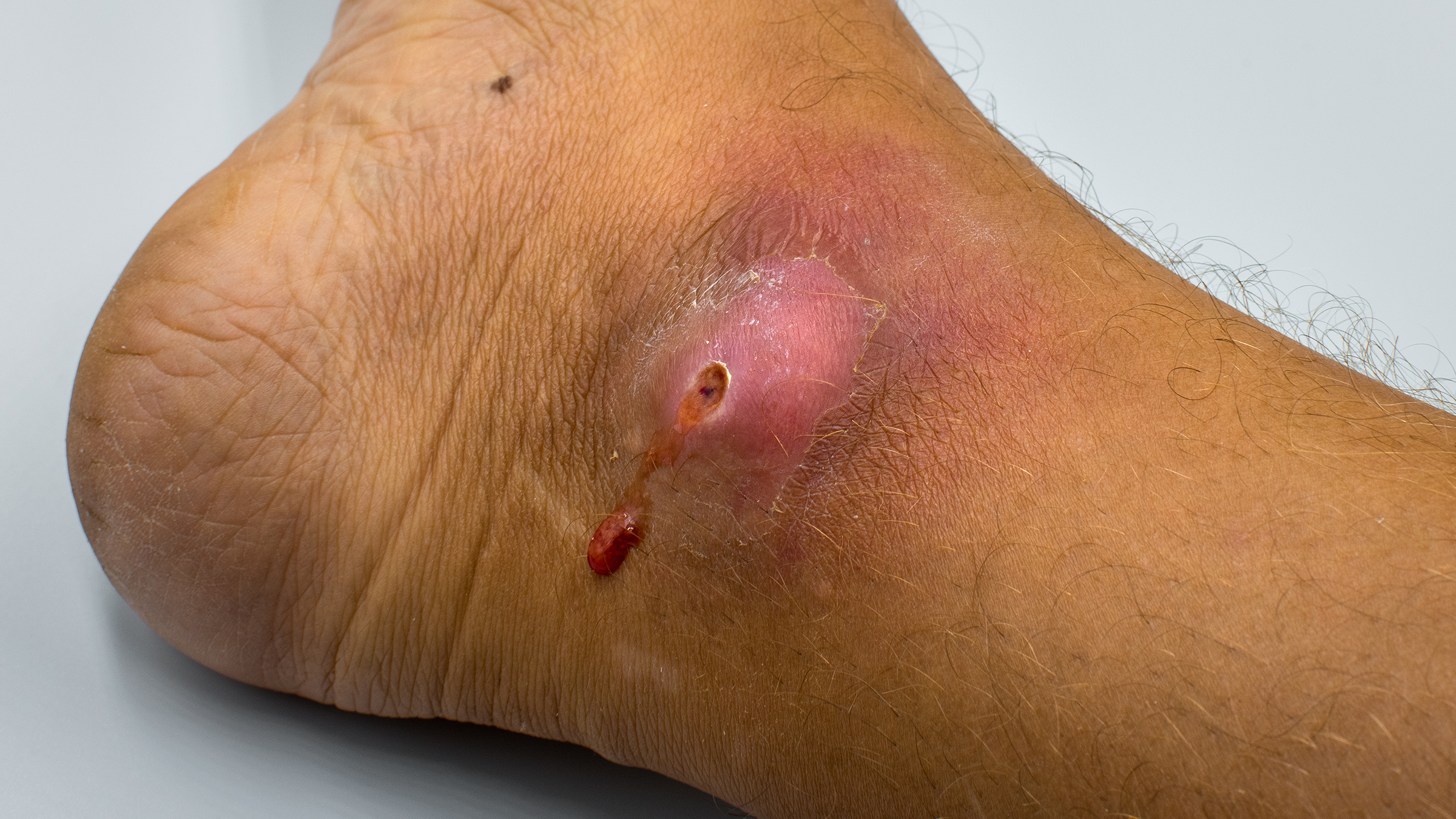 Infected Bed Sores