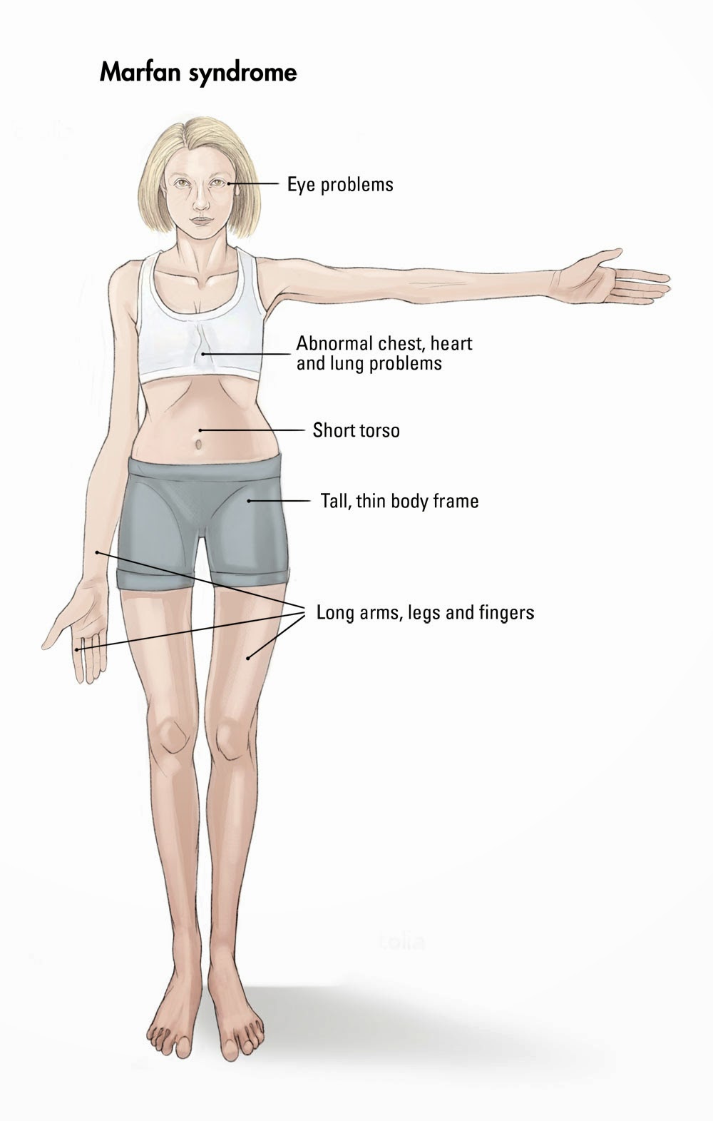 Marfan Syndrome Understanding The Genetic Puzzle And Its Impact On Marfan Syndrome Understanding The Genetic Puzzle And Its Impact On