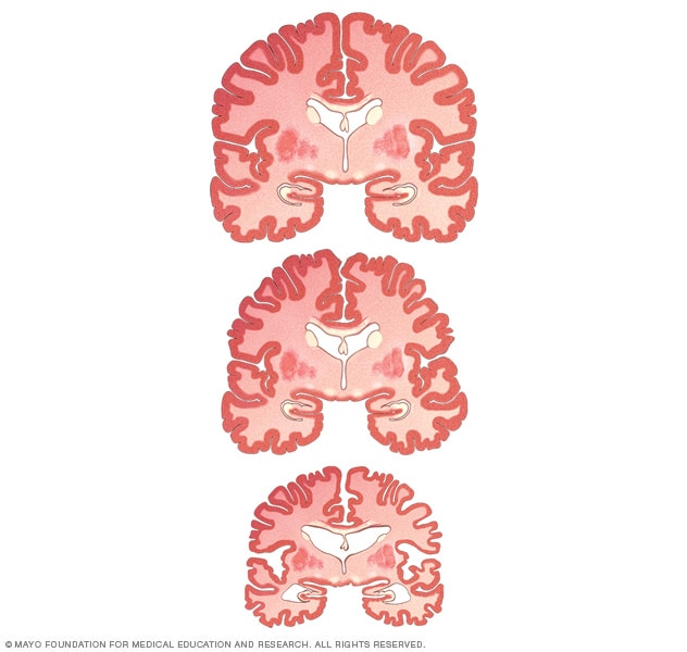 Mild Cognitive Impairment Mild Cognitive Impairment