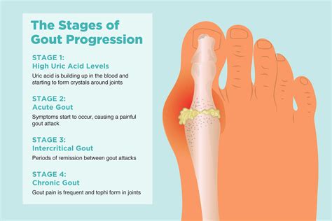 Pictures Of Gout On Bottom Of Foot Hotsell Emergencydentistry Com Pictures Of Gout On Bottom Of Foot Hotsell Emergencydentistry Com