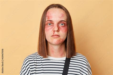 Serious Confident Woman In Striped Shirt With Bruised Skin Standing Serious Confident Woman In Striped Shirt With Bruised Skin Standing