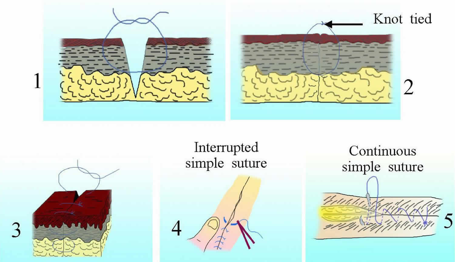 Suture Dehiscence In Patients With Connective Tissue Disease Marfan Suture Dehiscence In Patients With Connective Tissue Disease Marfan